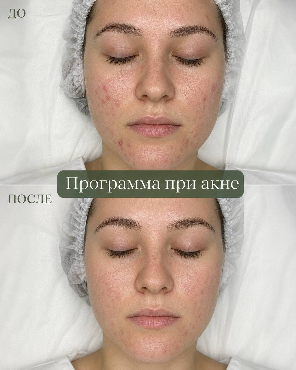 Программа при акне — до и после, в Клинцах