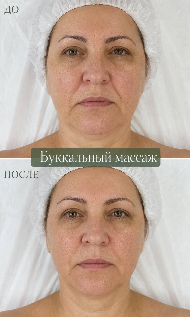 Буккальный массаж — до и после, в Клинцах