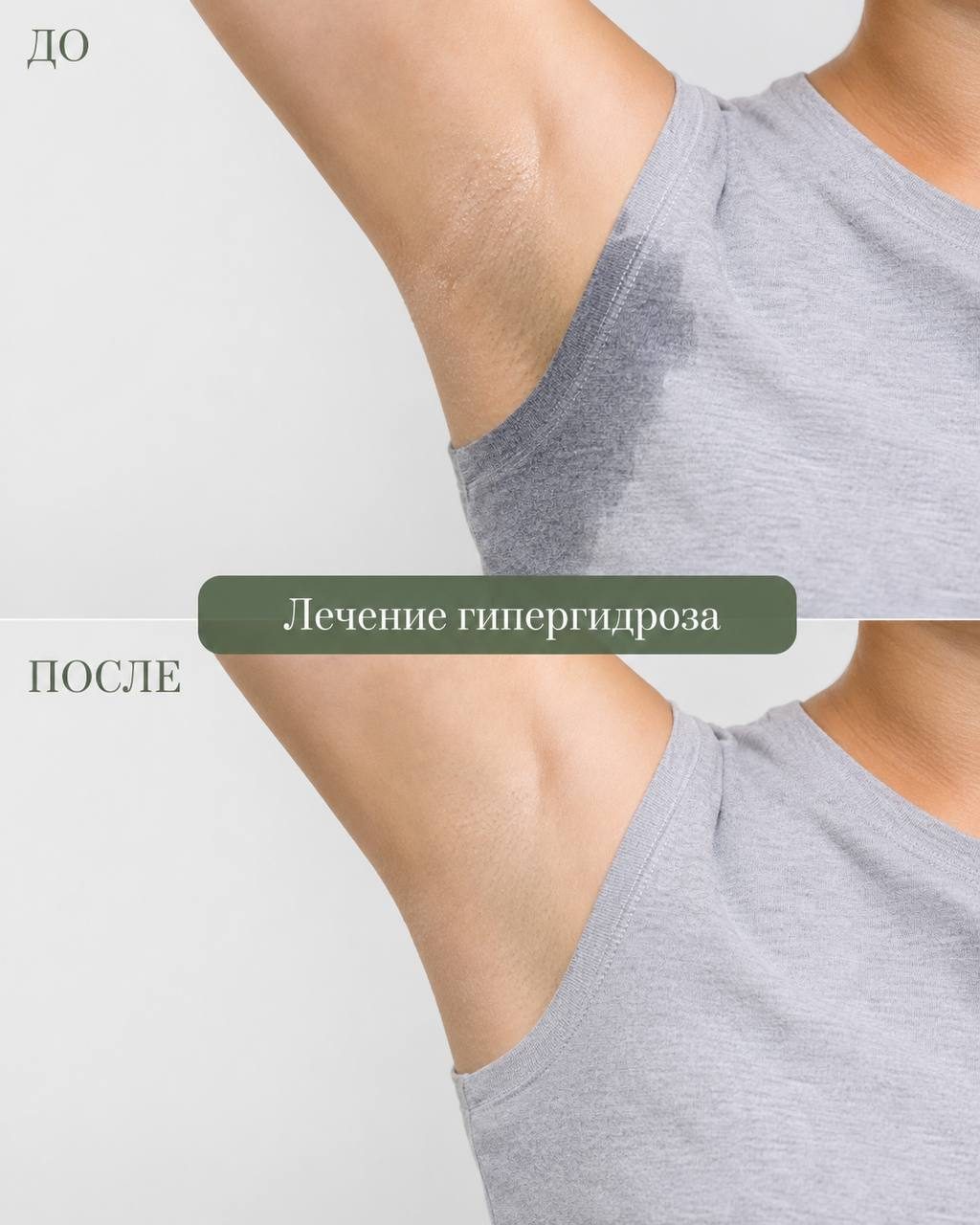 Лечение гипергидроза — до и после, в Клинцах