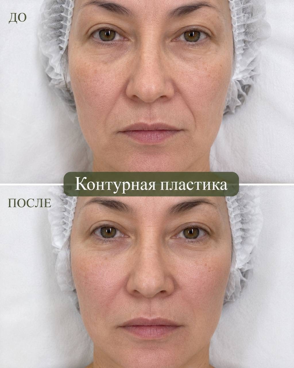 Контурная пластика — до и после, в Клинцах