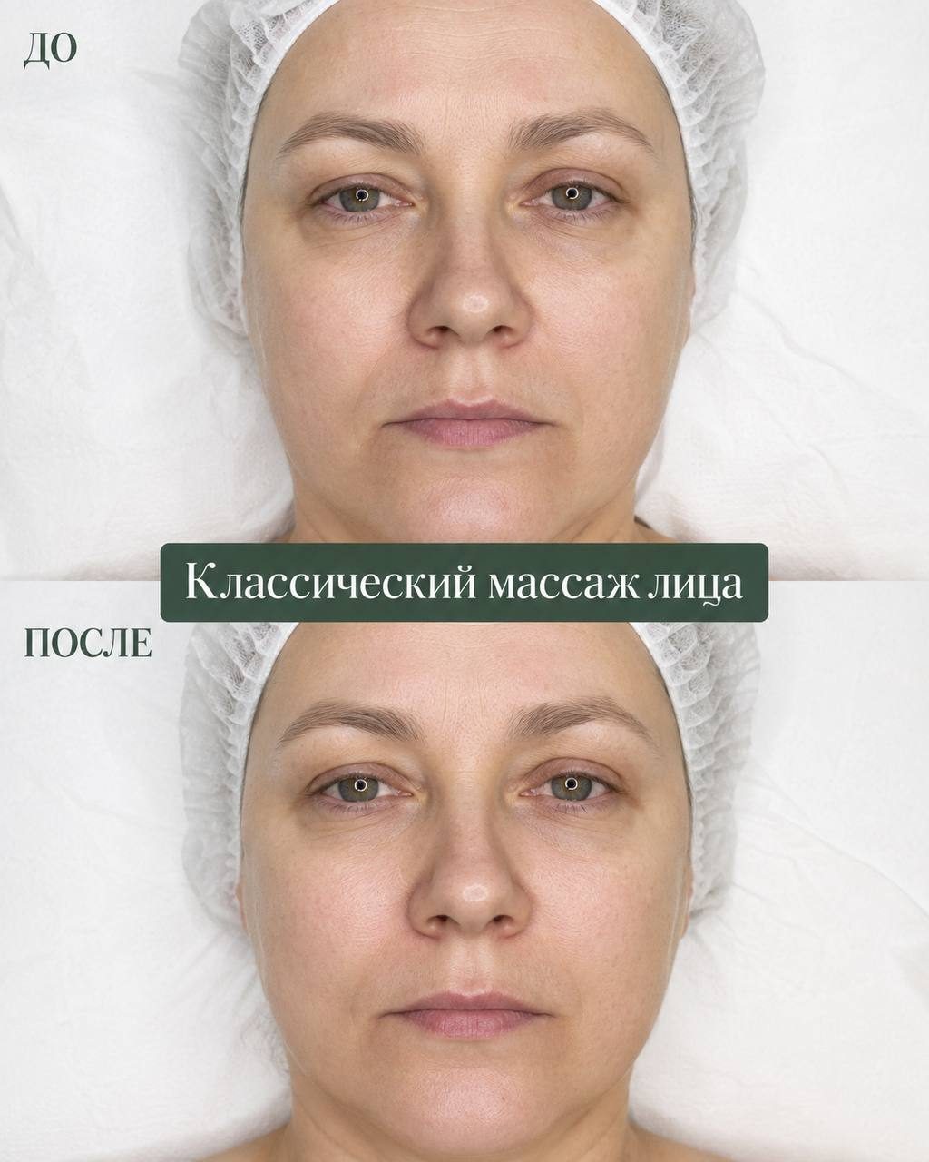 Классический массаж лица — до и после, в Клинцах