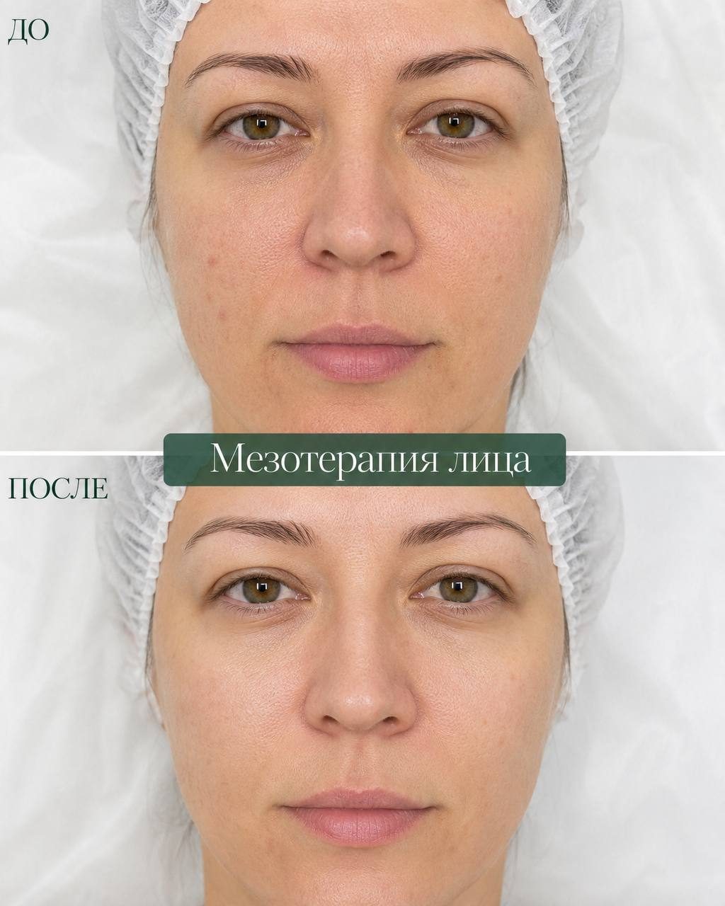 Мезотерапия лица — до и после, в Клинцах